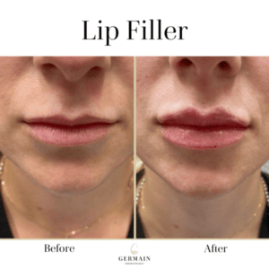 Brooke Lip Filler Before and After
