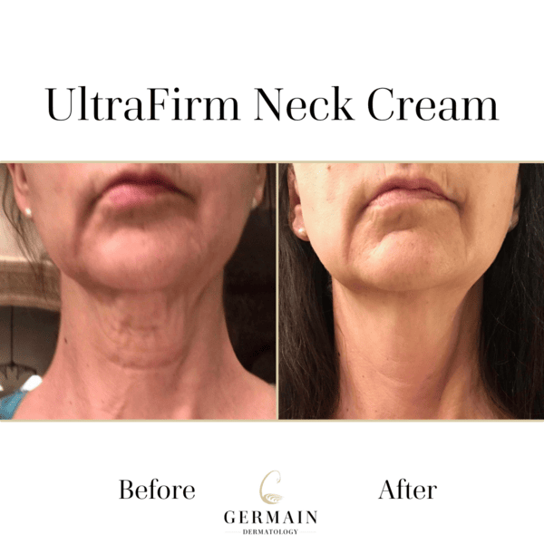 Copy of Ultrafirm Before and After