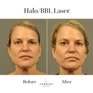 Halo/BBL Laser Before and after