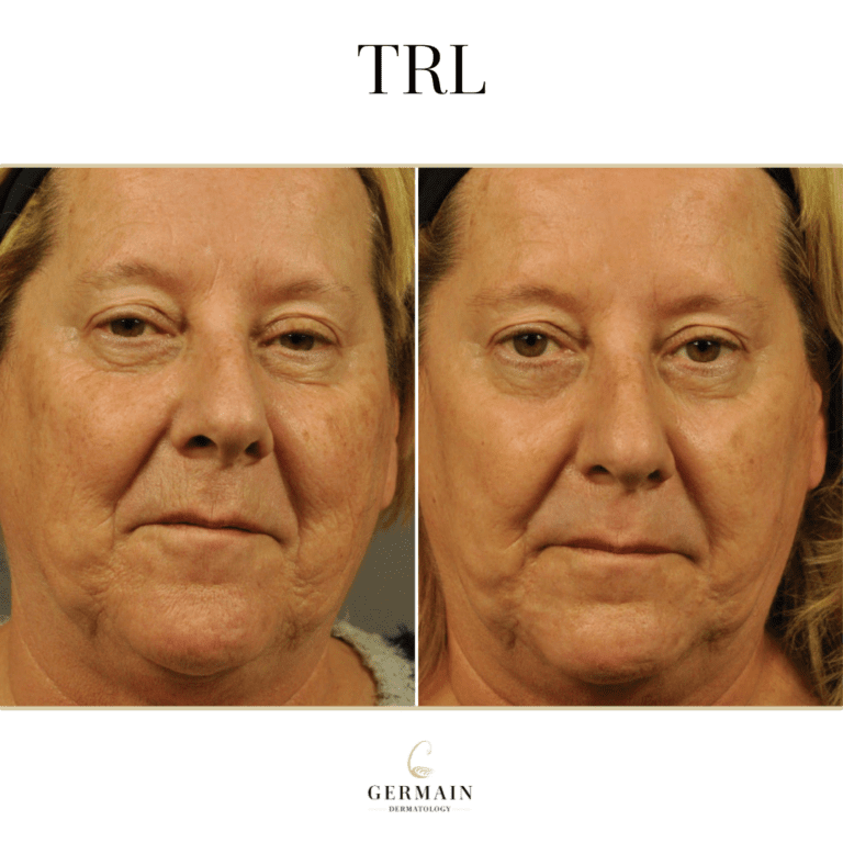 TRL BEFORE AND AFTERGermain Dermatology| Mt Pleasant, South Carolina