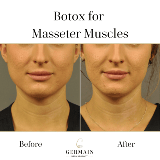 Botox Cosmetic _ Germain Dermatology