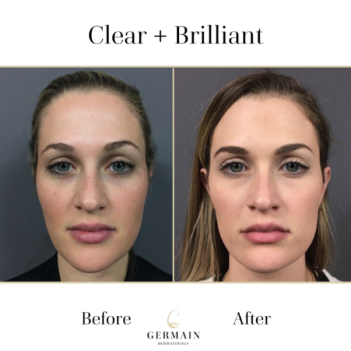 Clear+Brilliant Max_ Germain Dermatology