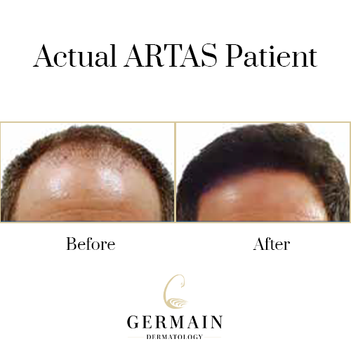 Artas before afterGermain Dermatology| Mt Pleasant, South Carolina