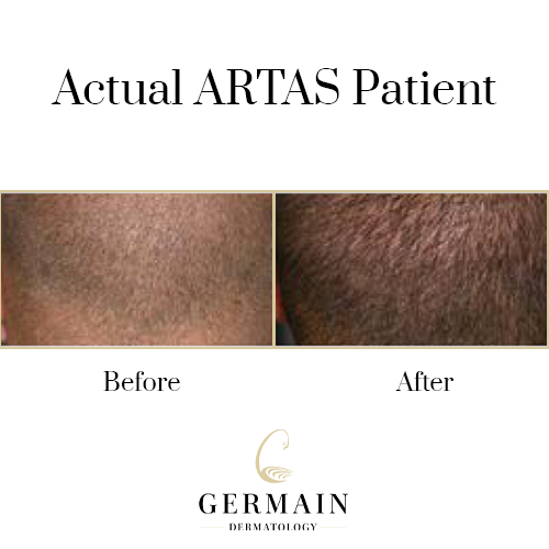 Artas before afterGermain Dermatology| Mt Pleasant, South Carolina
