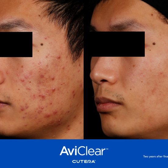 AviClear Before and afterGermain Dermatology| Mt Pleasant, South Carolina