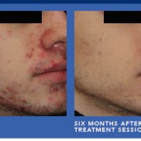 AviClear Before and afterGermain Dermatology| Mt Pleasant, South Carolina
