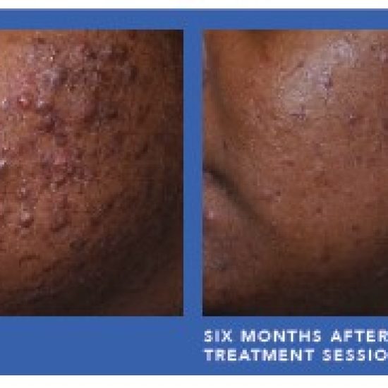 AviClear Before and afterGermain Dermatology| Mt Pleasant, South Carolina
