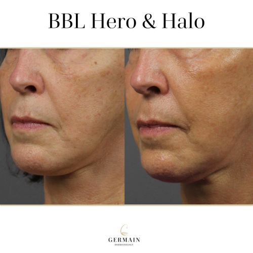 BBL Hero Before and AfterGermain Dermatology| Mt Pleasant, South Carolina