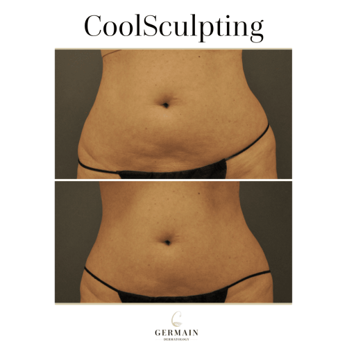 COOL SCULPTING BEFORE AND AFTER