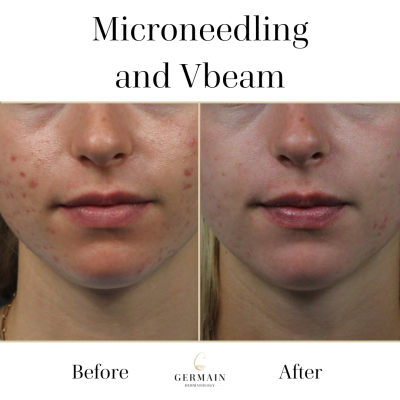 Laser Acne Microneedling _ Germain