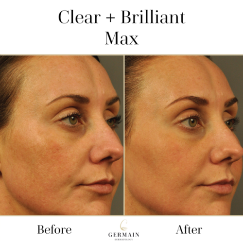 Clear+Brilliant Max_ Germain Dermatology