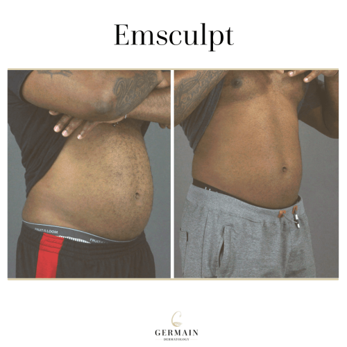EMSCULPT BEFORE AND AFTERGermain Dermatology| Mt Pleasant, South Carolina