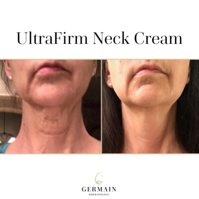 UltraFirm-Neck-Cream-Before-and-After