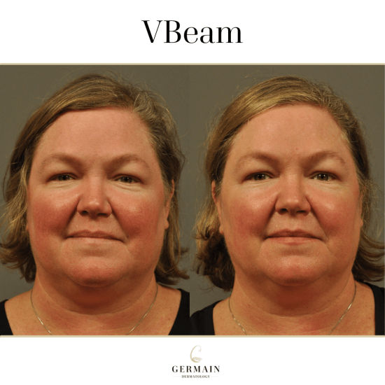 VBEAM BEFORE AND AFTERGermain Dermatology| Mt Pleasant, South Carolina