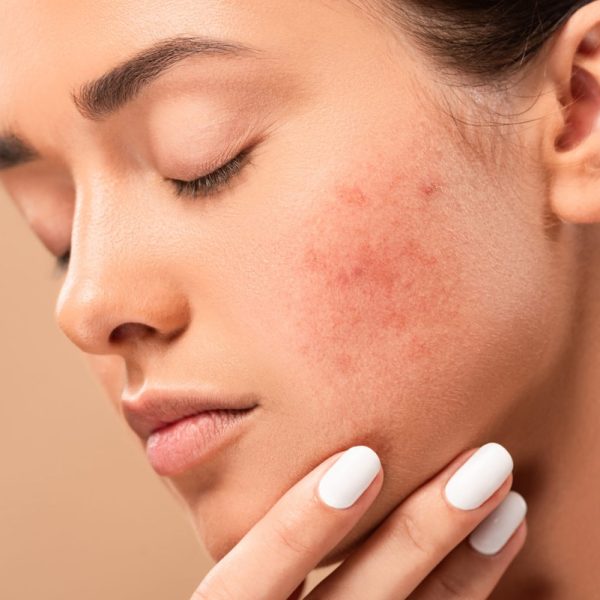 young woman with closed eyes touching face with acne isolated on beige