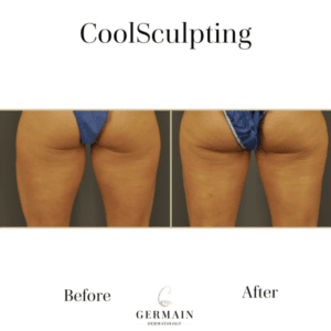 Coolsculpting _ Germain Dermatology