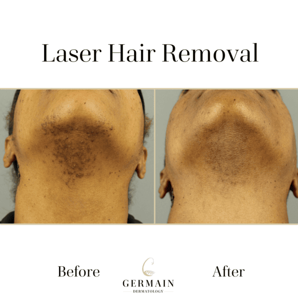 Laser Hair Removal Treatment | Mt Pleasant,at South Carolina