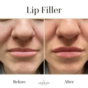 COLLAGEN & DERMAL FILLERS