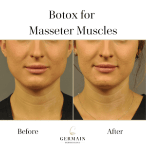 Botox for Masseter Muscles Before and after