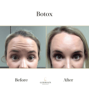 Botox before and after