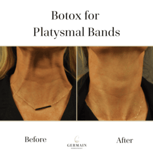 Botox Before and after