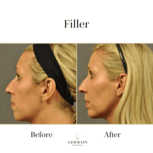 Filler Before and after