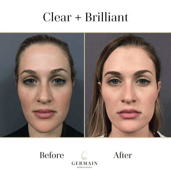 Clear + Brilliant Before and after