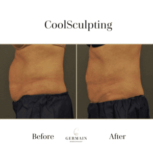 Coolsculpting Before and after