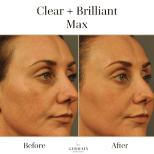 Copy of Clear + Brilliant Max Before and After