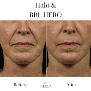 Halo and BBL Hero Before and After