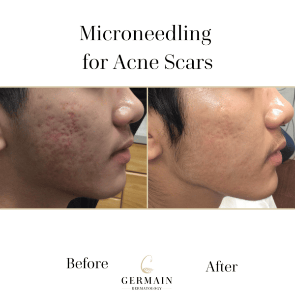 Microneedling for Acne Scars BA