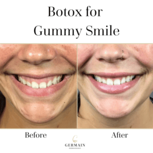 Gummy smile Before and After