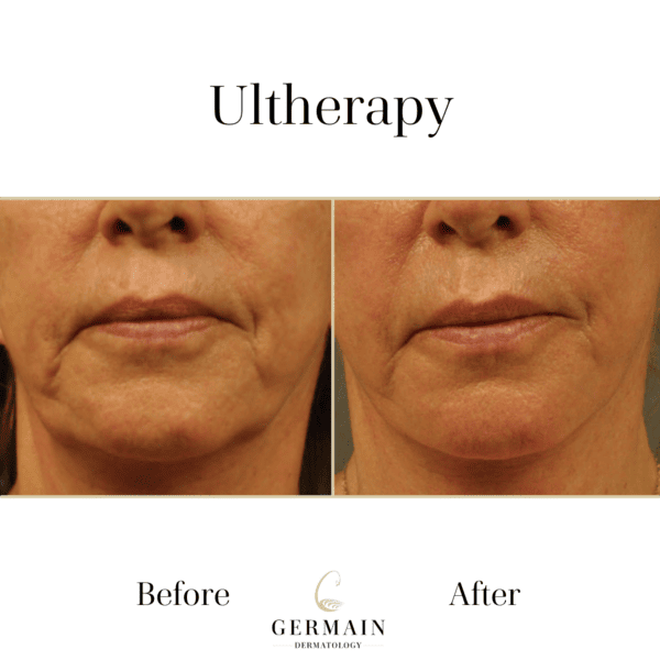 Copy of Ultherapy Before and After