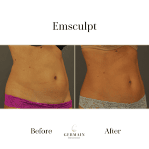 Emsculpt
