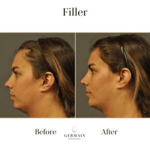 Filler Before and after