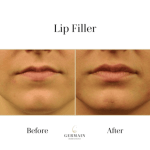 Lip filler Before and after