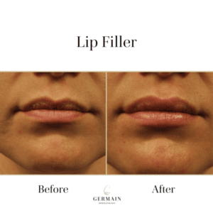 Lip filler Before and after