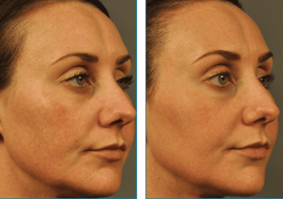 Before and after_Germain Dermatology