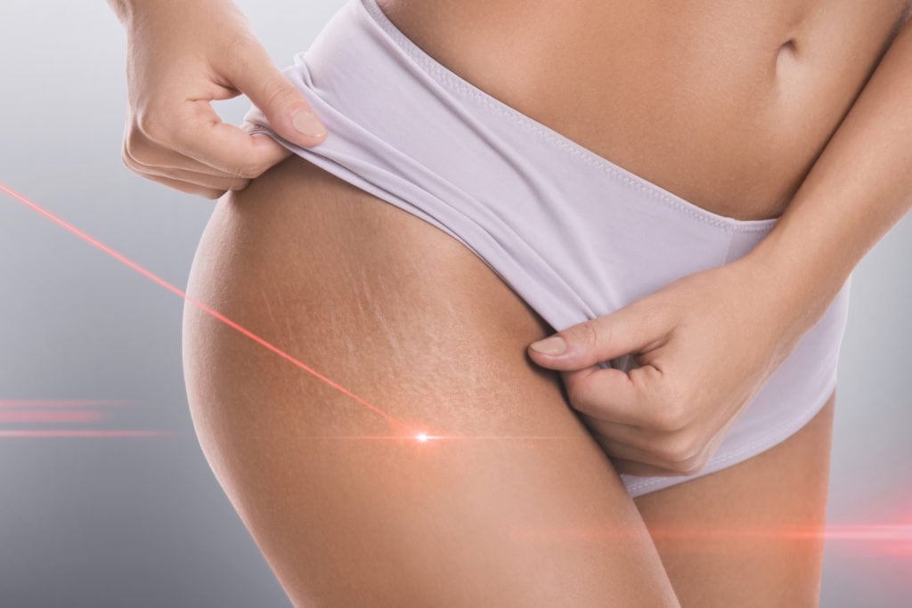 Stretch marks during laser removal session