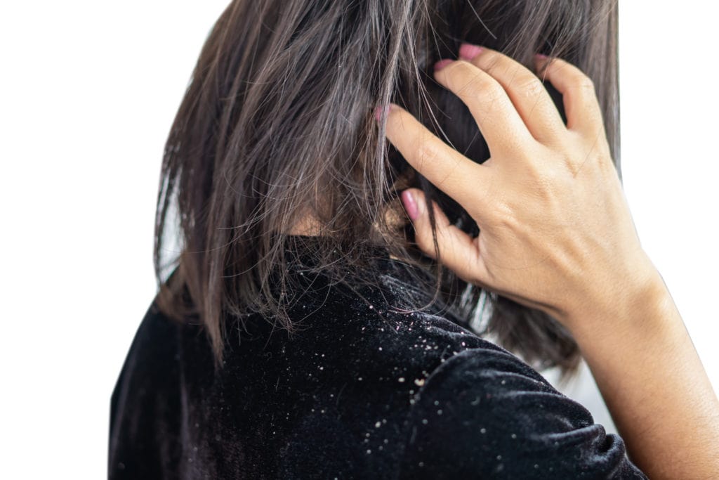 closeup woman hair having problem with dandruff on shoulder