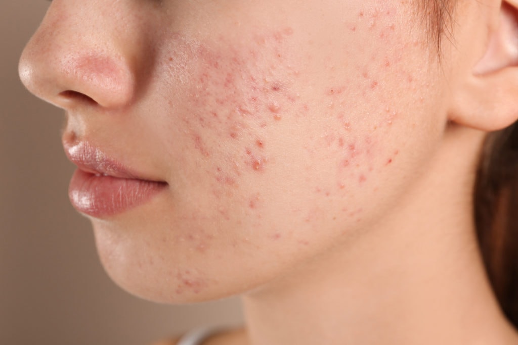Teenage girl with acne problem Germain Dermatology| Pawleys Island, SC