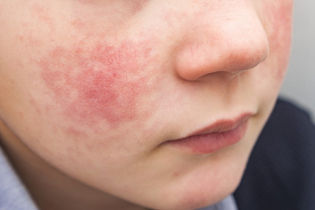 Boy with red cheeks AS RED AS RUDOLPH’S NOSE – ECZEMA