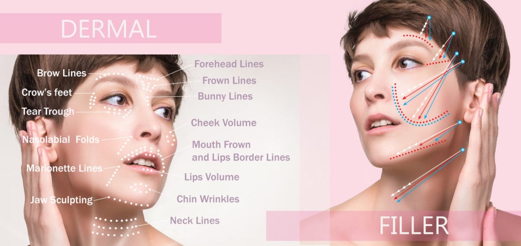 dermal filler treatmentGermain Dermatology| Summerville, South Carolina
