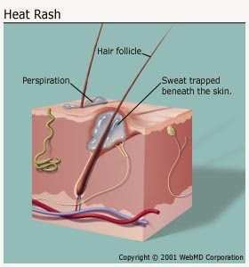 heat_rash