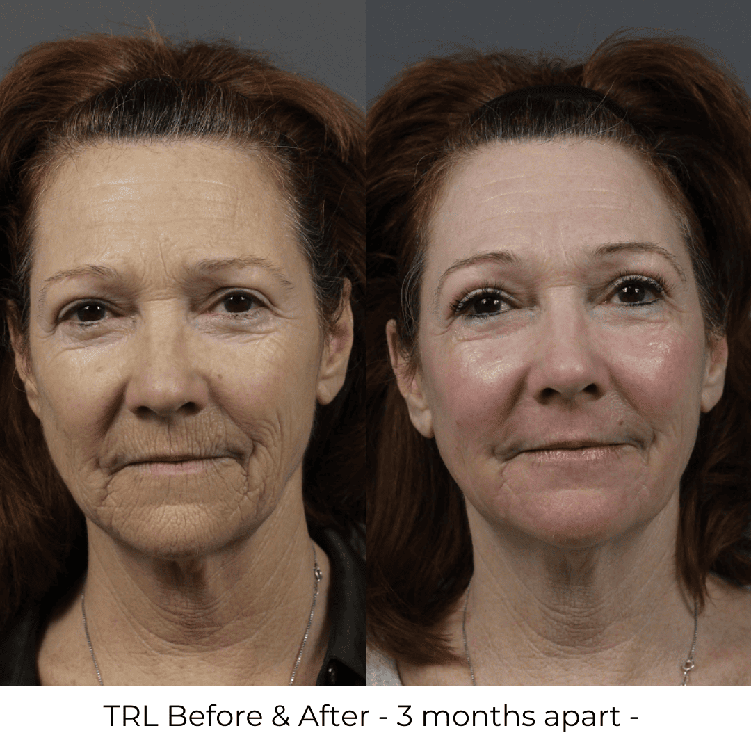 trl-laser-resurfacing-mt-pleasant-sc-germain-dermatology
