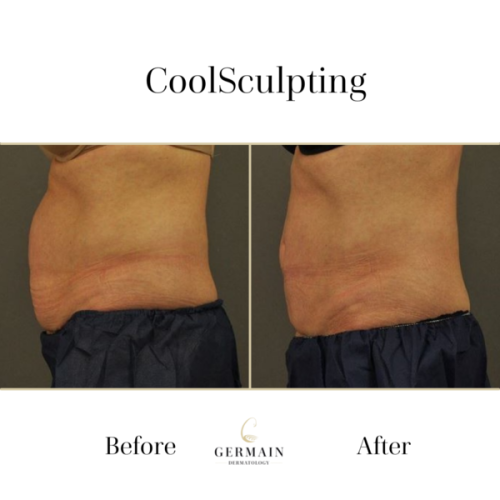 Coolsculpting _ Germain Dermatology