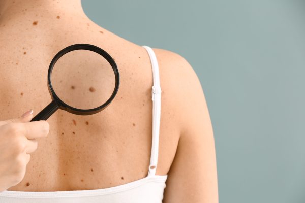 Skin cancer_ Germain Dermatology
