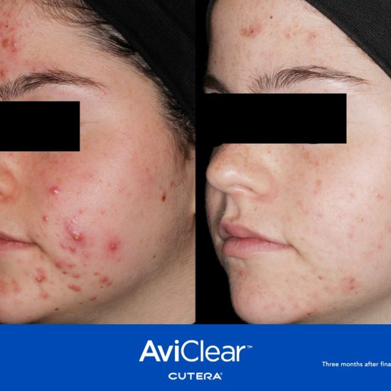 AviClear Before and after1