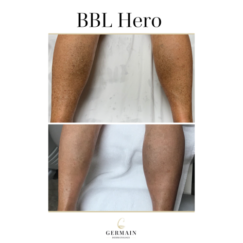 BBL Hero Before and AfterGermain Dermatology| Mt Pleasant, South Carolina