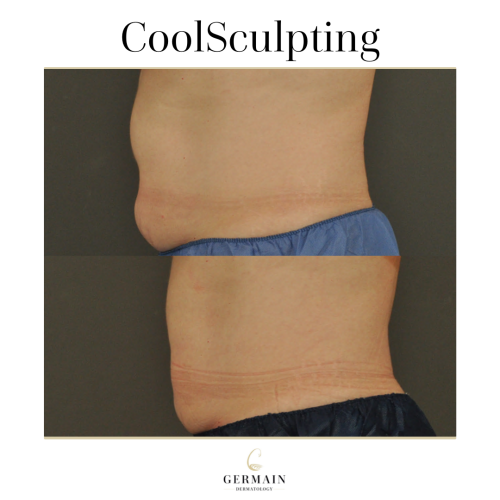 COOL SCULPTING BEFORE AND AFTER (1)